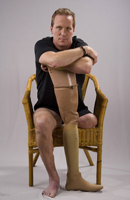 Jon with prosthetic